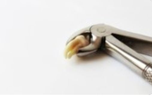 Inacreditável: médicos encontraram um dente nascendo no nariz de um homem