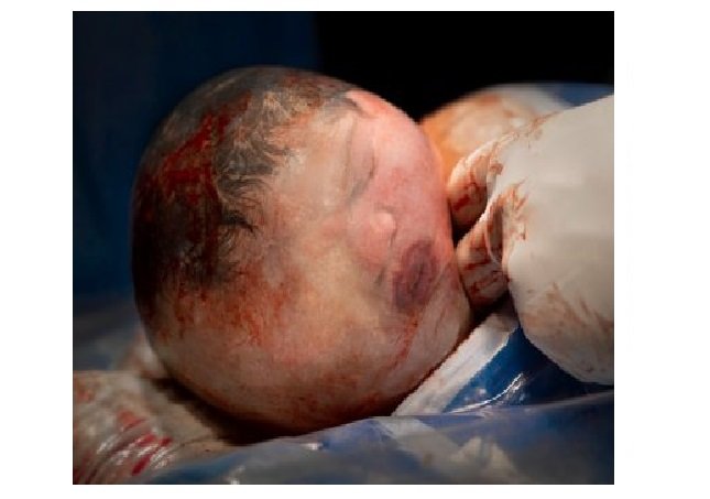 Bebê nasce empelicado e foto impressiona