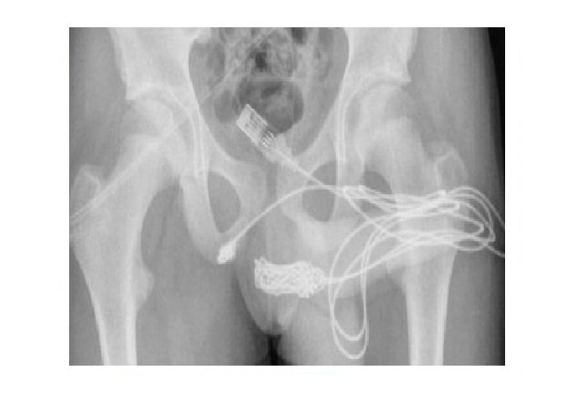 Adolescente passa por cirurgia após inserir cabo USB no pênis