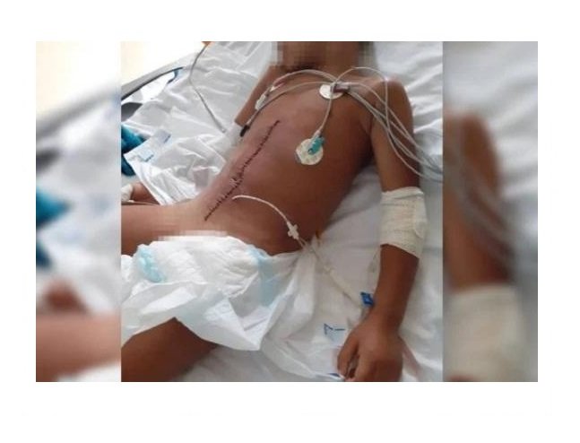 Menino cai de van escolar, é atropelado e sofre rompimentos na bacia e bexiga