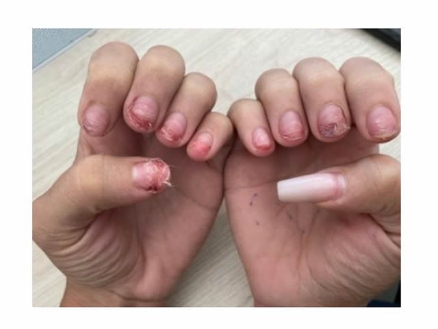 Mulher tem unhas arrancadas pelo marido durante briga em MT
