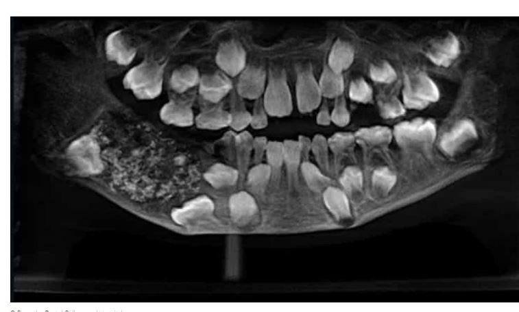Criança queixava-se de dores no maxilar. Descobriram 526 dentes na boca