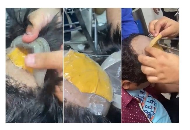 Homem é flagrado com ouro no ânus e debaixo da peruca