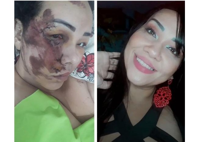 Faltando 6 meses para concurso, miss sofre acidente e fica com rosto deformado