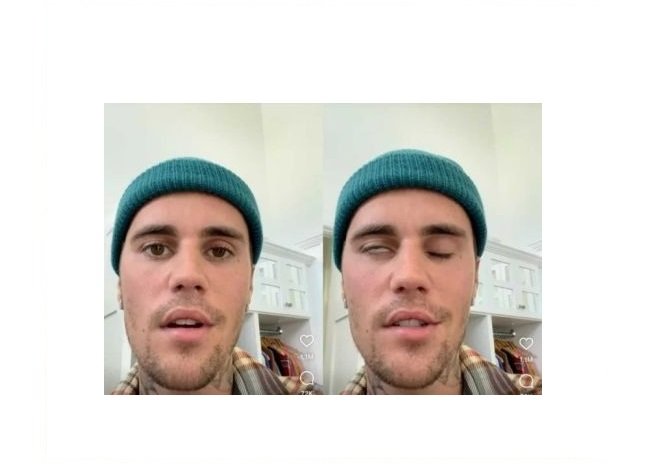 Conheça a síndrome que causou paralisia facial em Justin Bieber