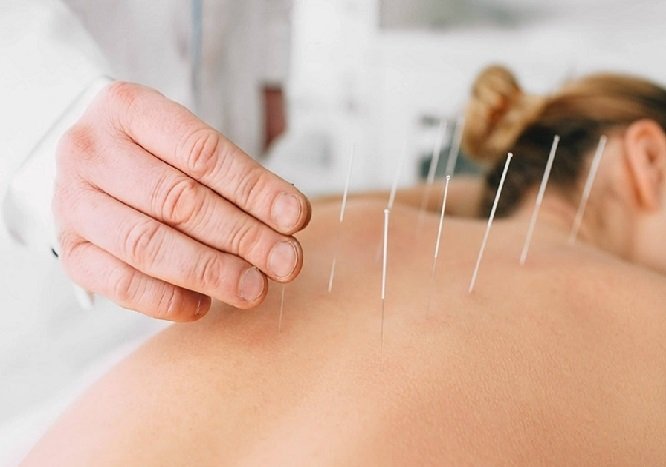 Acupuntura: quais as áreas beneficiadas por essa terapia?