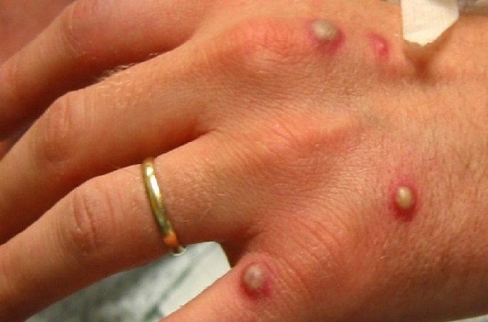 Segundo óbito por varíola do macaco é registrado no Brasil