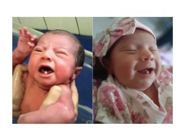 Bebê nasce com dois dentes e viraliza nas redes sociais