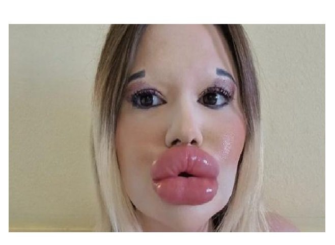 Por que o preenchimento labial que imita a boca da boneca Barbie pode ser fatal