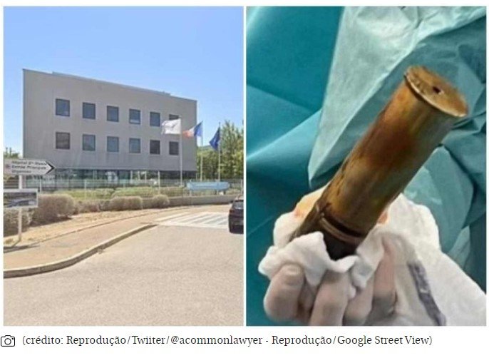Homem dá entrada em hospital com bomba no ânus e local tem de ser esvaziado