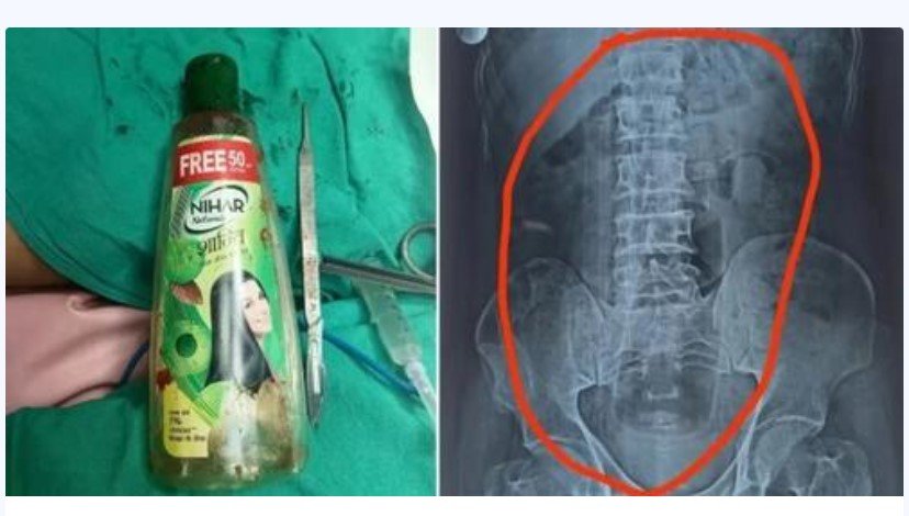 Homem tem garrafa de óleo retirada de estômago durante cirurgia