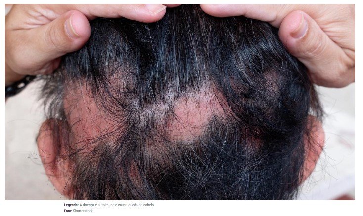 Anvisa aprova Baricitinibe, remédio usado contra alopecia areata; saiba mais