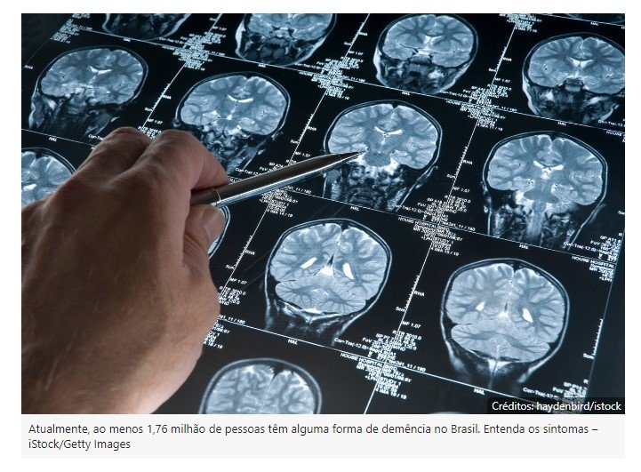 Demência: 4 primeiros sintomas que indicam a doença