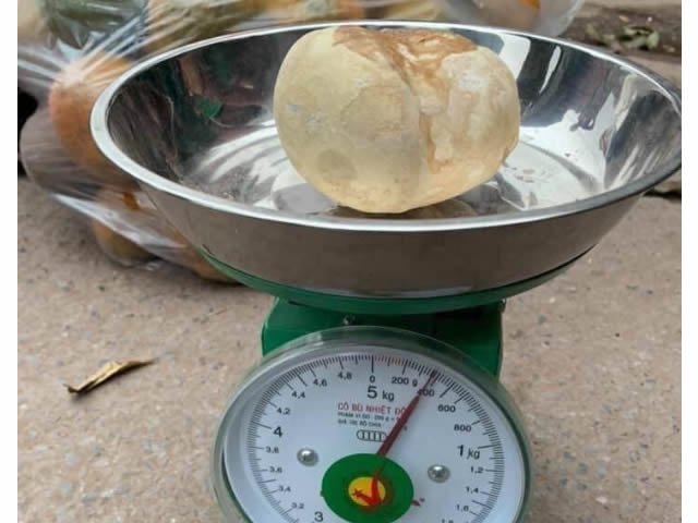 Mulher Vietnamita retira pedra de 400 gramas da bexiga