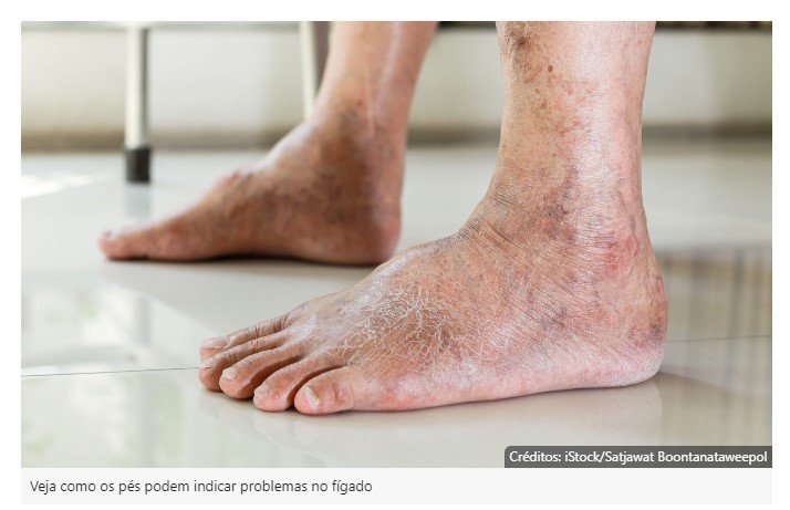 Conheça os sinais dos pés para problema no fígado, além de inchaço