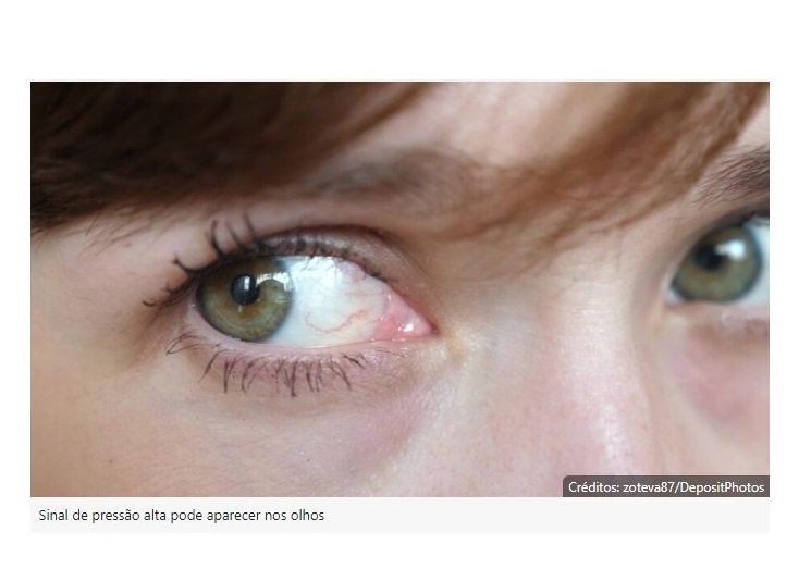 Olhos podem indicar sinal de pressão alta; saiba identificar