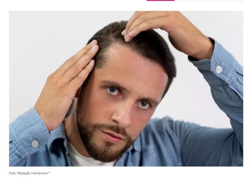 Minoxidil nos cabelos: versão em comprimido tem o mesmo efeito