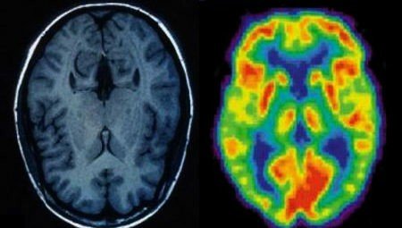 Drogas sintéticas podem reverter danos em pacientes com Alzheimer, diz estudo