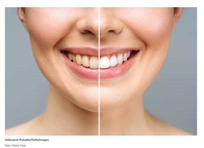 A receita para deixar os dentes brancos é muito mais simples do que você imagina