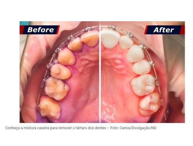 A mistura caseira que ajuda a remover o tártaro dos dentes de forma eficaz