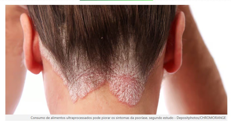Estudo descobre alimento que pode agravar as crises de psoríase