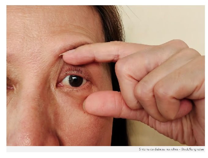 Sintoma nos olhos que pode sinalizar diabetes fora de controle