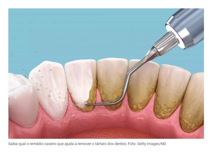 O remédio caseiro que ajuda a remover o tártaro dos dentes, segundo especialistas