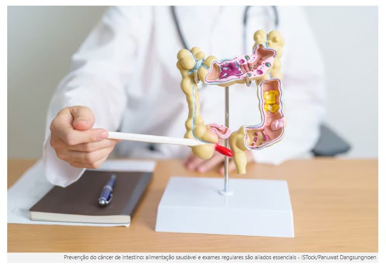 Câncer de intestino: estudo com 70 mil pessoas aponta vitamina que reduz risco da doença