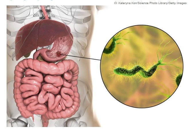 Médico aponta chá anti-inflamatório que ajuda a combater a H. pylori