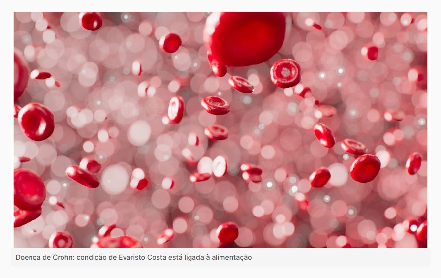 Doença de Crohn: condição de Evaristo Costa está ligada à alimentação