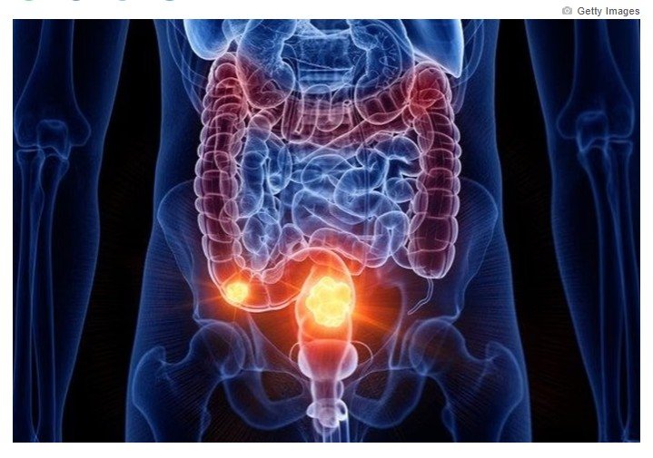 Câncer de intestino: saiba como é feita e quando começar a prevenção