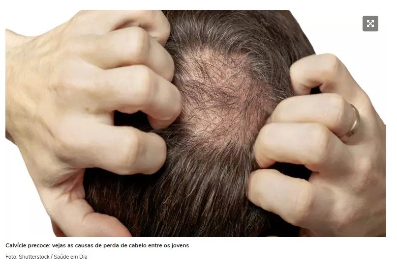 Calvície precoce: causas e impactos da perda de cabelo entre os jovens