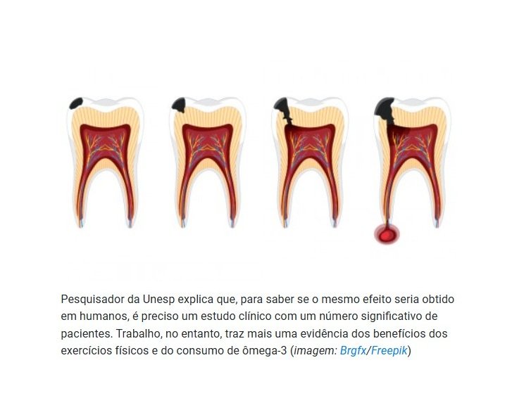 Combinação de exercício físico e ômega-3 reduz gravidade de infecção na raiz do dente.
