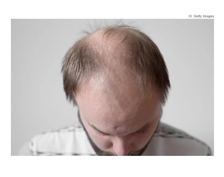 Careca doce: composto de estévia faz crescer 67% mais cabelo em calvos