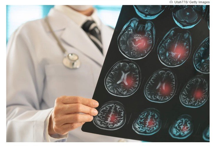 Neurologista alerta para sintomas leves que podem surgir antes do AVC
