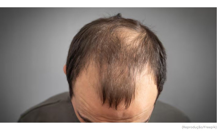 Cientistas do Taiwan descobrem novo tratamento que faz crescer cabelo até em calvos