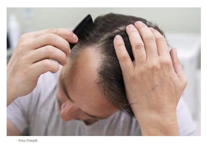 Melhor que minoxidil e finasterida: nova fórmula promete superar resultados de tratamento tradicional para calvície