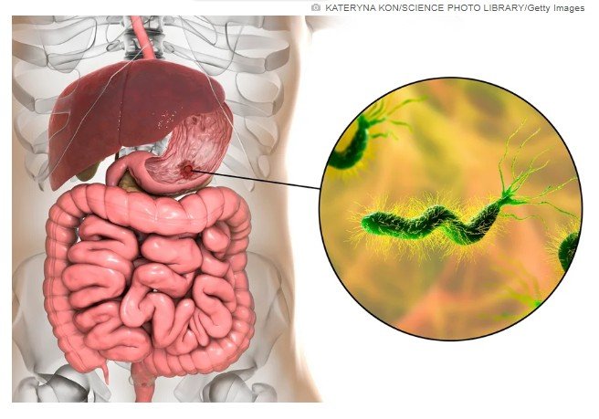 Gastroenterologista lista formas mais comuns de infecção da H. pylori