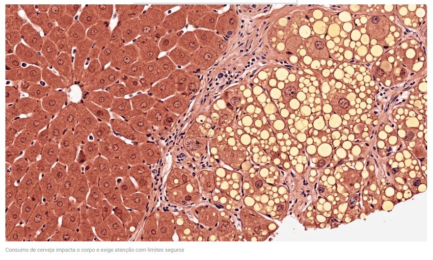Estudo mostra os efeitos da cerveja no fígado e na saúde cardiovascular
