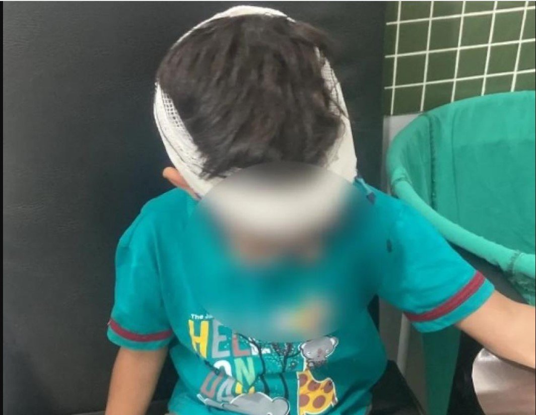 Menino atacado por macaco é transferido por falta de soro antirrábico.
