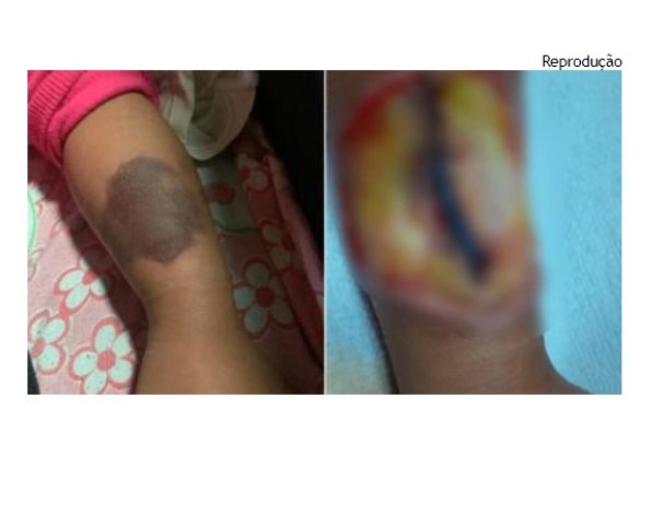 Menina que perdeu parte do braço após injeção espera tratamento