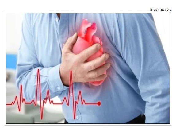 Internações por infarto crescem 229% em Mato Grosso