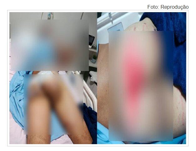 Paciente opera o nariz e sai de cirurgia com queimaduras de segundo grau nas nádegas