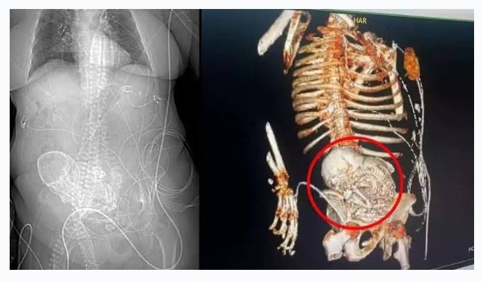 Idosa descobre que carregou bebê calcificado no ventre por 56 anos