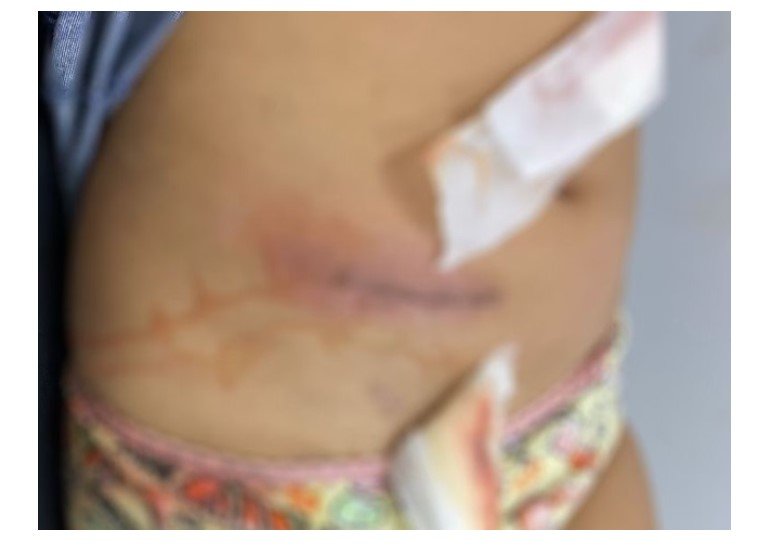 Sorriso: Médicos 'esquecem' resíduos dentro de criança após cirurgia no HRS, menina contrai infecção e bactéria, e precisa de outras duas cirurgias para 'resolver' problema