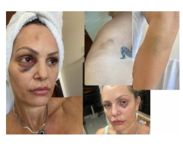 Personal expõe marcas de agressões e levanta suspeitas sobre morte
