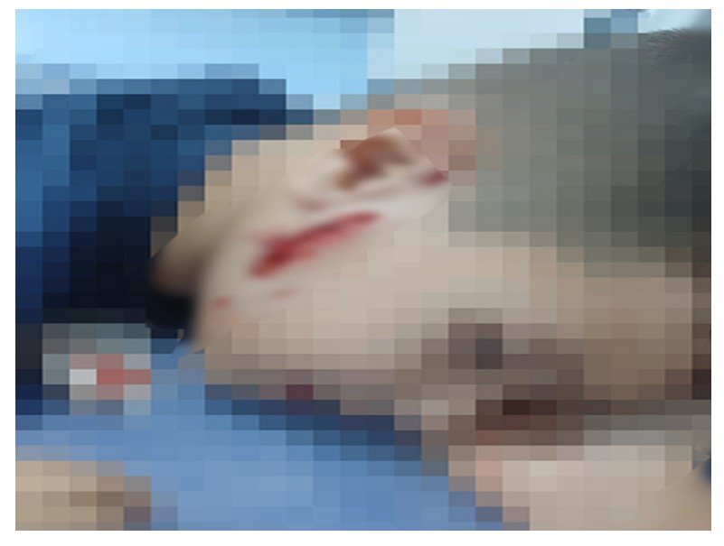 Cachorro solto na rua ataca e quase mata criança em cidade de MT.