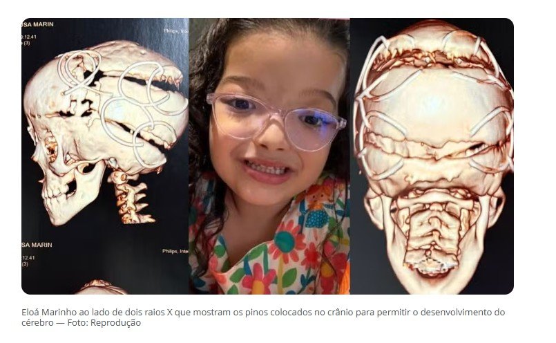 Criança com doença rara no crânio passa por 4ª cirurgia para evitar danos ao cérebro em MT