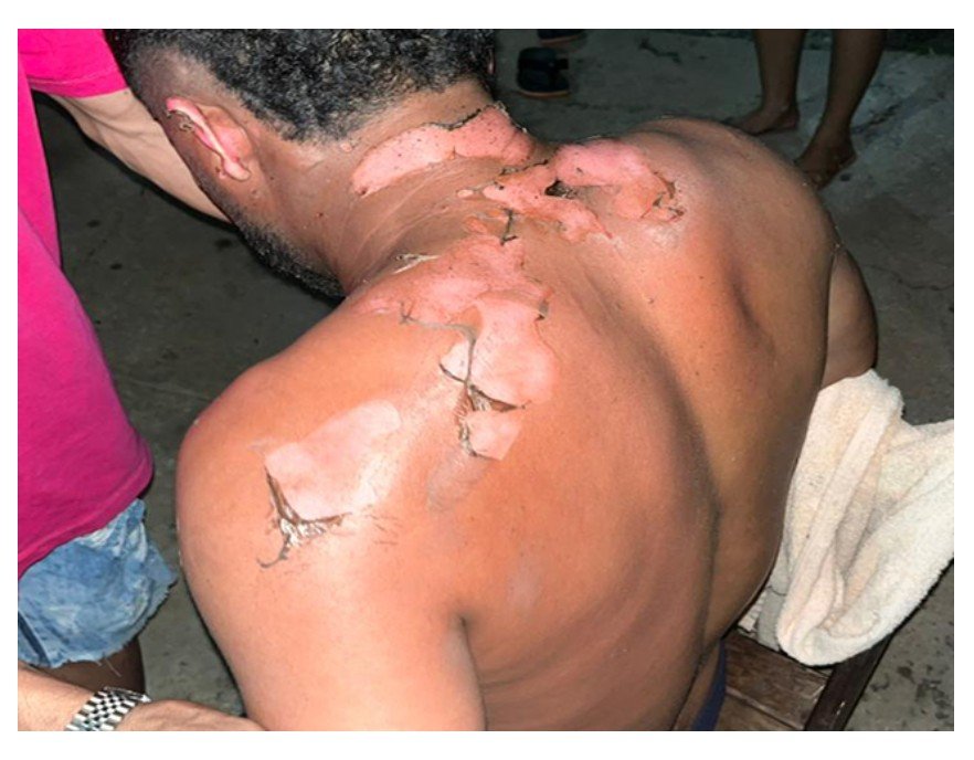 Mulher coloca fogo no marido após eles brigarem por término de relacionamento
