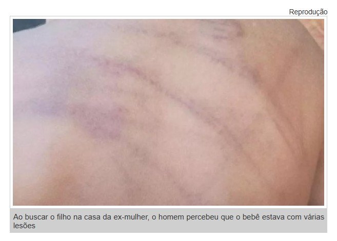 Bebê de 1 ano é internado com sinais de espancamento em Barra do Garças